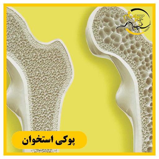 متخصص پوکی استخوان در شیراز