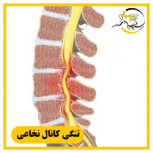 تنگی کانال نخاعی