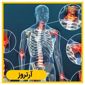 آرتروز کمر (اسپوندیلوز) چیست؟ علائم، علل و روشهای درمان مؤثر در شیراز