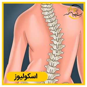 درمان اسکولیوز (انحراف ستون فقرات) بدون جراحی در شیراز | فیزیوتراپی سیناطب