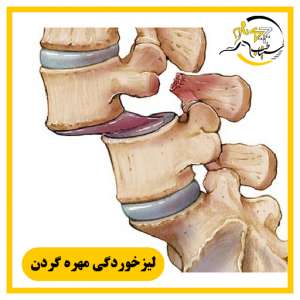 درمان لیزخوردگی مهره گردن در شیراز | نجات ستون فقرات بدون جراحی (سیناطب)