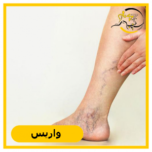 درمان واریس با آبدرمانی در شیراز