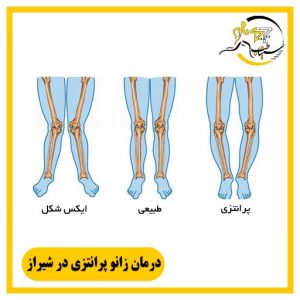 Treatment of knee braces in Shiraz , درمان زانو پرانتزی در شیراز